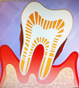 4.重度歯周病
